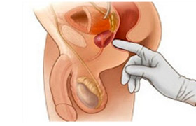 Behandlung von Prostatitis