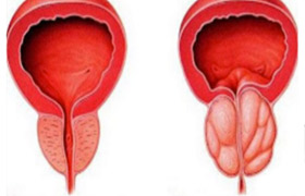 Prävention Prostatitis