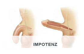 Impotenz